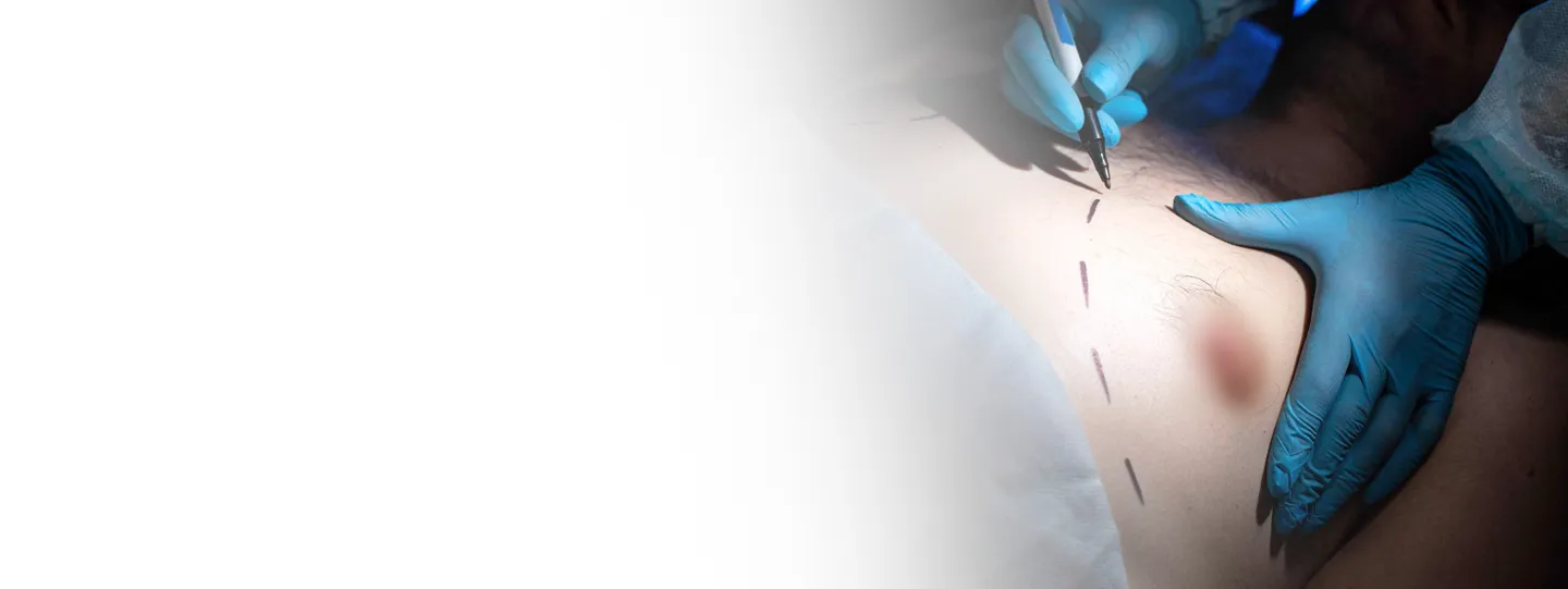 Gyno Surgery Cost in India: Procedure, Types & Best Hospitals Near You